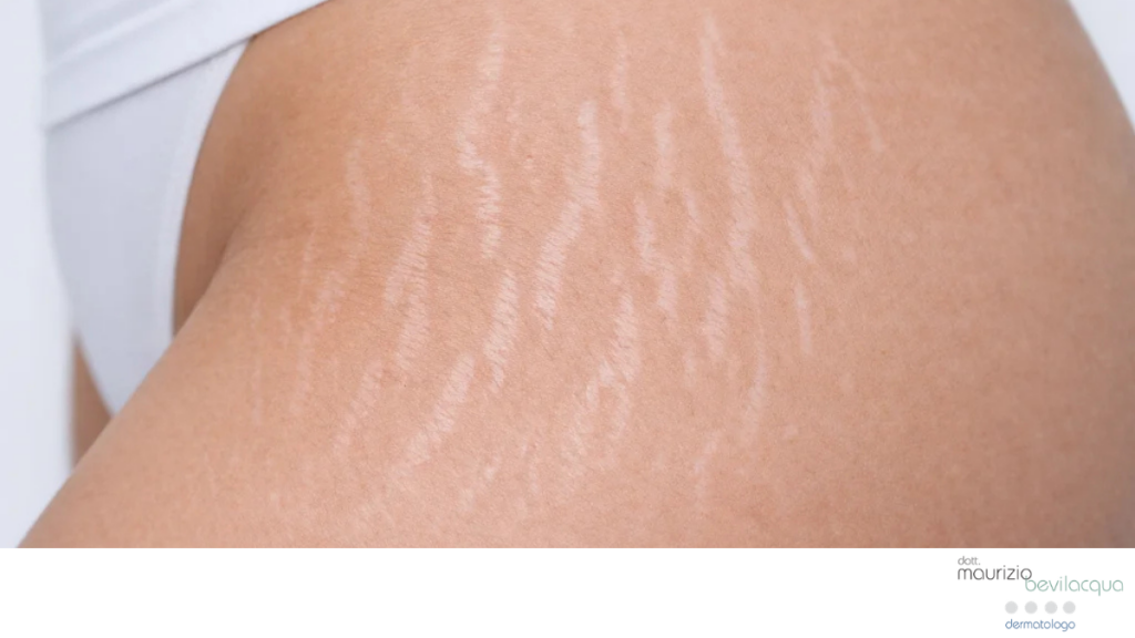 Come trattare le smagliature della pelle?
